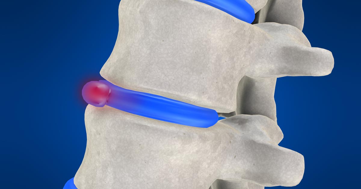 Tumwater non-surgical disc herniation treatment